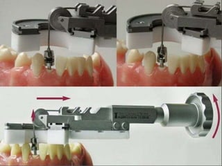 Recent advancements in procedures of atraumatic extraction of teeth | PPTX