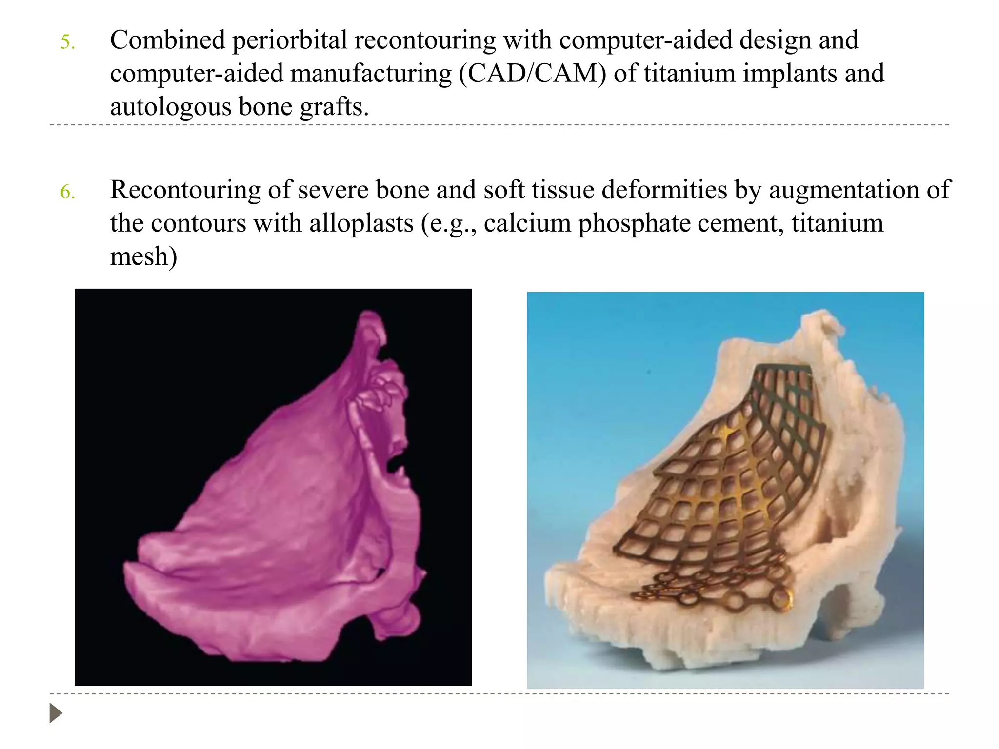 Recent advances in maxillofacial trauma | PPTX