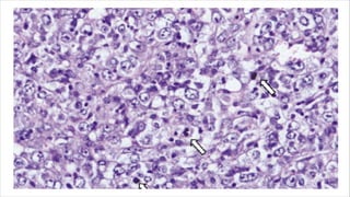 RECENT ADVANCES- SOFT TISSUE TUMOURS.pdf