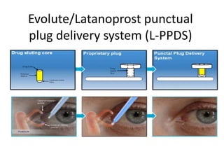 Evolute R Delivery System Recent advances for anti glaucoma drugs delivery.pptx