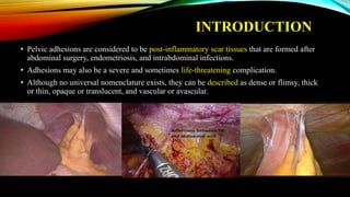INTRODUCTION
• Pelvic adhesions are considered to be post-inflammatory scar tissues that are formed after
abdominal surgery, endometriosis, and intrabdominal infections.
• Adhesions may also be a severe and sometimes life-threatening complication.
• Although no universal nomenclature exists, they can be described as dense or flimsy, thick
or thin, opaque or translucent, and vascular or avascular.
 