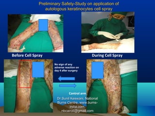 Recent advances in burns management by Dr. Sunil Keswani, National ...
