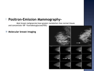  Positron-Emission Mammography-
Most breast malignancies have greater metabolism than normal tissues
and concentrate 18F- fluorodeoxyglucose(FDG)
 Molecular breast imaging
 