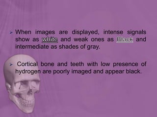  When images are displayed, intense signals
show as and weak ones as and
intermediate as shades of gray.
 Cortical bone and teeth with low presence of
hydrogen are poorly imaged and appear black.
 