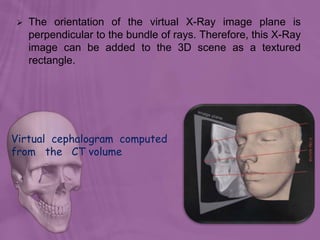  The orientation of the virtual X-Ray image plane is
perpendicular to the bundle of rays. Therefore, this X-Ray
image can be added to the 3D scene as a textured
rectangle.
Virtual cephalogram computed
from the CT volume
 