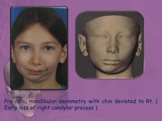 Pre op -, mandibular asymmetry with chin deviated to Rt. (
Early loss of right condylar process )
 