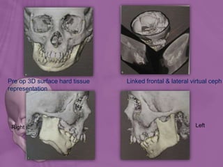 Pre op 3D surface hard tissue
representation
Linked frontal & lateral virtual ceph
Right Left
 
