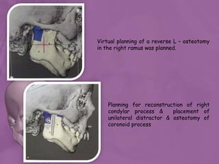 Virtual planning of a reverse L – osteotomy
in the right ramus was planned.
Planning for reconstruction of right
condylar process & placement of
unilateral distractor & osteotomy of
coronoid process
 