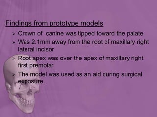 Findings from prototype models
 Crown of canine was tipped toward the palate
 Was 2.1mm away from the root of maxillary right
lateral incisor
 Root apex was over the apex of maxillary right
first premolar
 The model was used as an aid during surgical
exposure.
 