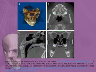 STANDARD DISPLAY MODES OF CBCT VOLUMETRIC DATA. (A) VOLUMETRIC 3D REPRESENTATION OF
HARD TISSUE SHOWING THE THREE ORTHOGONAL PLANES IN RELATION TO THE RECONSTRUCTED
VOLUMETRIC DATA SET; EACH ORTHOGONAL PLANE HAS MULTIPLE THIN-SLICE SECTIONS IN EACH
PLANE. (B) REPRESENTATIVE AXIAL IMAGE. (C) REPRESENTATIVE SAGITTAL IMAGE, AND (D)
REPRESENTATIVE CORONAL IMAGE
 