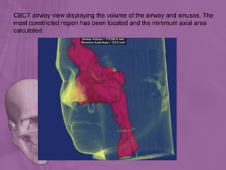 CBCT airway view displaying the volume of the airway and sinuses. The
most constricted region has been located and the minimum axial area
calculated
 