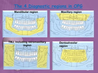 20
The 4 Diagnostic regions in OPG
Dentoalveolar
region
Maxillary regionMandibular region
TMJ, including retromaxillary
region
 