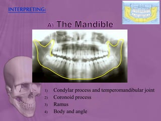 INTERPRETING:
1) Condylar process and temperomandibular joint
2) Coronoid process
3) Ramus
4) Body and angle
 