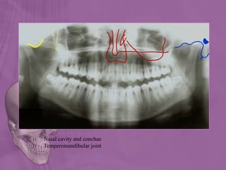 1) Nasal cavity and conchae
2) Temperomandibular joint
 