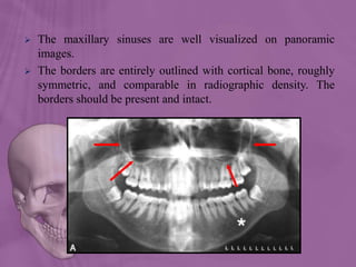  The maxillary sinuses are well visualized on panoramic
images.
 The borders are entirely outlined with cortical bone, roughly
symmetric, and comparable in radiographic density. The
borders should be present and intact.
 