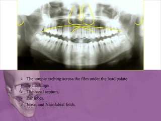  The tongue arching across the film under the hard palate
 lip markings
 The nasal septum,
 Ear lobes,
 Nose, and Nasolabial folds.
 