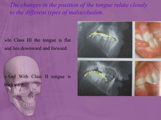 The changes in the position of the tongue relate closely
to the different types of malocclusion.
In Class III the tongue is flat
and lies downward and forward.
And With Class II tongue is
backward.
 
