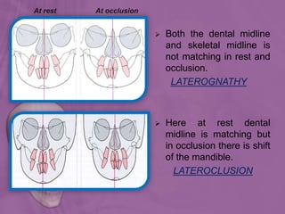  Both the dental midline
and skeletal midline is
not matching in rest and
occlusion.
LATEROGNATHY
 Here at rest dental
midline is matching but
in occlusion there is shift
of the mandible.
LATEROCLUSION
At rest At occlusion
 