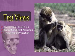  Transcranial Projection
 Transpharyngeal Projection
 Transorbital Projection
 