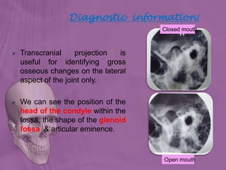 Diagnostic information:
 Transcranial projection is
useful for identifying gross
osseous changes on the lateral
aspect of the joint only.
 We can see the position of the
head of the condyle within the
fossa, the shape of the glenoid
fossa & articular eminence.
Closed mouth
Open mouth
 