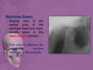 Structures Shown:
 Sagittal view of the
medial pole of the
condylar head and neck,
usually taken in the
open mouth position.
 This view is effective for
visualizing erosive
changes of the condyle.
 
