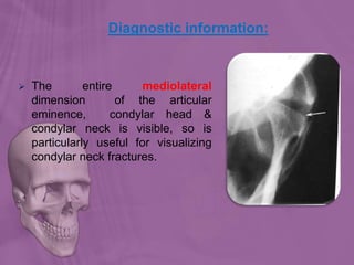 Diagnostic information:
 The entire mediolateral
dimension of the articular
eminence, condylar head &
condylar neck is visible, so is
particularly useful for visualizing
condylar neck fractures.
 