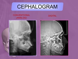 CONVENTIONAL
(ANALOG)
DIGITAL
CEPHALOGRAM
 