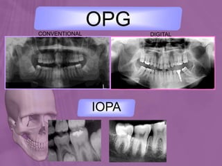 CONVENTIONAL DIGITAL
OPG
IOPA
 