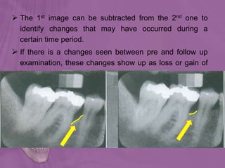  The 1st image can be subtracted from the 2nd one to
identify changes that may have occurred during a
certain time period.
 If there is a changes seen between pre and follow up
examination, these changes show up as loss or gain of
hard tissues.
 