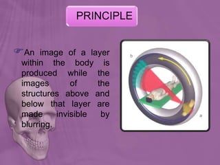 An image of a layer
within the body is
produced while the
images of the
structures above and
below that layer are
made invisible by
blurring.
PRINCIPLE
 