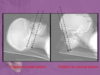 Position for axial section Position for coronal section
 