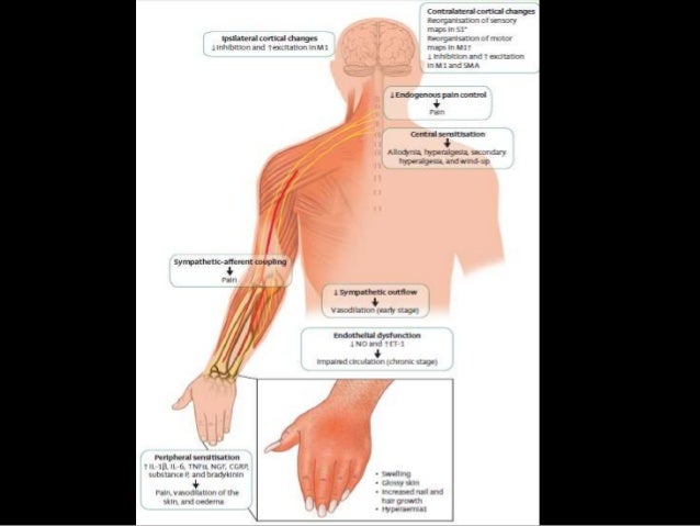 Recent Advances In Crps Physiotherapy Perspective