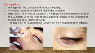 Nasal packing
1. to keep the mucosa taut and reduce bleeding.
2. 4% topical lignocaine instilled first in the I/L nostril
3. nasal pack (roller gauze soaked in 2% lignocaine-adrenaline) inserted in
the I/L nostril with the help of nasal packing forceps in the direction of
medial palpebral ligament (MPL)
4. The direction of nasal packing is superior, then posterior, then inferior.
 