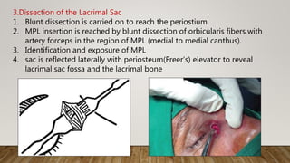 3.Dissection of the Lacrimal Sac
1. Blunt dissection is carried on to reach the periostium.
2. MPL insertion is reached by blunt dissection of orbicularis fibers with
artery forceps in the region of MPL (medial to medial canthus).
3. Identification and exposure of MPL
4. sac is reflected laterally with periosteum(Freer’s) elevator to reveal
lacrimal sac fossa and the lacrimal bone
 