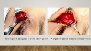 Kerrison punch being used to create a bony osteum A large bony osteum exposing the nasal mucosa
 