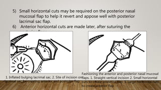 5) Small horizontal cuts may be required on the posterior nasal
mucosal flap to help it revert and appose well with posterior
lacrimal sac flap.
6) Anterior horizontal cuts are made later, after suturing the
posterior flaps.
1. Inflated bulging lacrimal sac. 2. Site of incision on
lacrimal sac for creating anterior and posterior flap
Fashioning the anterior and posterior nasal mucosal
flaps. 1. Straight vertical incision 2. Small horizontal
cuts to create posterior flap. 3. Large horizontal cuts
to create anterior flap
 