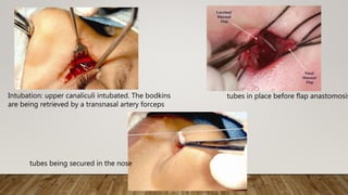 Intubation: upper canaliculi intubated. The bodkins
are being retrieved by a transnasal artery forceps
tubes being secured in the nose
tubes in place before flap anastomosis
 