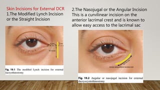 Skin Incisions for External DCR
1.The Modified Lynch Incision
or the Straight Incision
2.The Nasojugal or the Angular Incision
This is a curvilinear incision on the
anterior lacrimal crest and is known to
allow easy access to the lacrimal sac
 