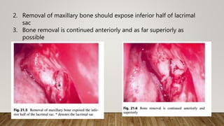 2. Removal of maxillary bone should expose inferior half of lacrimal
sac
3. Bone removal is continued anteriorly and as far superiorly as
possible
 