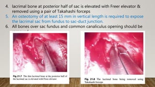 4. lacrimal bone at posterior half of sac is elevated with Freer elevator &
removed using a pair of Takahashi forceps
5. An osteotomy of at least 15 mm in vertical length is required to expose
the lacrimal sac from fundus to sac-duct junction.
6. All bones over sac fundus and common canaliculus opening should be
removed.
 