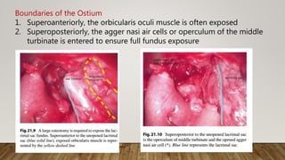 Boundaries of the Ostium
1. Superoanteriorly, the orbicularis oculi muscle is often exposed
2. Superoposteriorly, the agger nasi air cells or operculum of the middle
turbinate is entered to ensure full fundus exposure
 