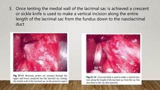 3. Once tenting the medial wall of the lacrimal sac is achieved a crescent
or sickle knife is used to make a vertical incision along the entire
length of the lacrimal sac from the fundus down to the nasolacrimal
duct
 