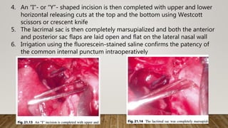 4. An “I”- or “Y”- shaped incision is then completed with upper and lower
horizontal releasing cuts at the top and the bottom using Westcott
scissors or crescent knife
5. The lacrimal sac is then completely marsupialized and both the anterior
and posterior sac flaps are laid open and flat on the lateral nasal wall
6. Irrigation using the fluorescein-stained saline confirms the patency of
the common internal punctum intraoperatively
 