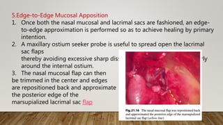 5.Edge-to-Edge Mucosal Apposition
1. Once both the nasal mucosal and lacrimal sacs are fashioned, an edge-
to-edge approximation is performed so as to achieve healing by primary
intention.
2. A maxillary ostium seeker probe is useful to spread open the lacrimal
sac flaps
thereby avoiding excessive sharp dissection within the sac, particularly
around the internal ostium.
3. The nasal mucosal flap can then
be trimmed in the center and edges
are repositioned back and approximate
the posterior edge of the
marsupialized lacrimal sac flap
 