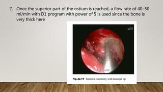 7. Once the superior part of the ostium is reached, a flow rate of 40–50
ml/min with D1 program with power of 5 is used since the bone is
very thick here
 