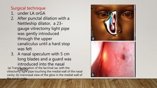 Surgical technique
1. under LA orGA
2. After punctal dilation with a
Nettleship dilator, a 23-
gauge vitrectomy light pipe
was gently introduced
through the upper
canaliculus until a hard stop
was felt
3. A nasal speculum with 5 cm
long blades and a guard was
introduced into the nasal
cavity.(a) Transillumination of the lacrimal sac with the
vitrectomy light pipe touching the medial wall of the nasal
cavity; (b) transnasal view of the glow in the medial wall of
the nasal cavity
 