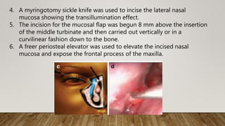4. A myringotomy sickle knife was used to incise the lateral nasal
mucosa showing the transillumination effect.
5. The incision for the mucosal flap was begun 8 mm above the insertion
of the middle turbinate and then carried out vertically or in a
curvilinear fashion down to the bone.
6. A freer periosteal elevator was used to elevate the incised nasal
mucosa and expose the frontal process of the maxilla.
 