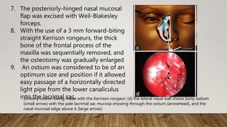 7. The posteriorly-hinged nasal mucosal
flap was excised with Weil-Blakesley
forceps.
8. With the use of a 3 mm forward-biting
straight Kerrison rongeurs, the thick
bone of the frontal process of the
maxilla was sequentially removed, and
the osteotomy was gradually enlarged
9. An ostium was considered to be of an
optimum size and position if it allowed
easy passage of a horizontally directed
light pipe from the lower canaliculus
into the lacrimal sac.(c) bony ostium being made with the Kerrison rongeur; (d) the lateral nasal wall shows bony ostium
(small arrow) with the pale lacrimal sac mucosa showing through the ostium (arrowhead), and the
nasal mucosal edge above it (large arrow);
 