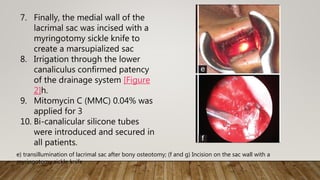 7. Finally, the medial wall of the
lacrimal sac was incised with a
myringotomy sickle knife to
create a marsupialized sac
8. Irrigation through the lower
canaliculus confirmed patency
of the drainage system [Figure
2]h.
9. Mitomycin C (MMC) 0.04% was
applied for 3
10. Bi-canalicular silicone tubes
were introduced and secured in
all patients.
e) transillumination of lacrimal sac after bony osteotomy; (f and g) Incision on the sac wall with a
myringotomy sickle knife
 