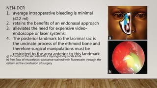 g) Incision on the sac wall with a myringotomy sickle knife
h) free flow of viscoelastic substance stained with fluorescein through the
ostium at the conclusion of surgery
NEN-DCR
1. average intraoperative bleeding is minimal
(≤12 ml)
2. retains the benefits of an endonasal approach
3. alleviates the need for expensive video-
endoscope or laser systems.
4. The posterior landmark to the lacrimal sac is
the uncinate process of the ethmoid bone and
therefore surgical manipulations must be
restricted to the area anterior to this landmark
 